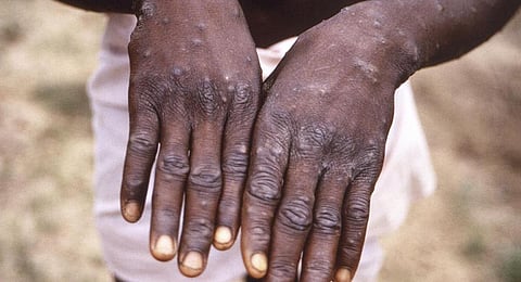 குரங்கு அம்மை அறிகுறிகளுடன் வருபவர்களை கண்காணிப்பது அவசியம்: அனைத்து மாவட்ட சுகாதார அதிகாரிகளுக்கு அறிவுரை