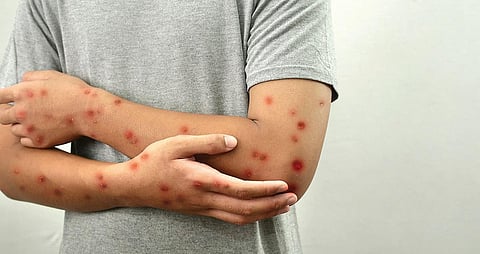 குரங்கு அம்மை: அச்சம் வேண்டாம்