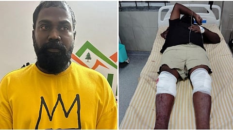 காலில் காயமடைந்து மருத்துவமனையில் சிகிச்சை பெற்று வரும் ரவுடி ஆல்வின்.