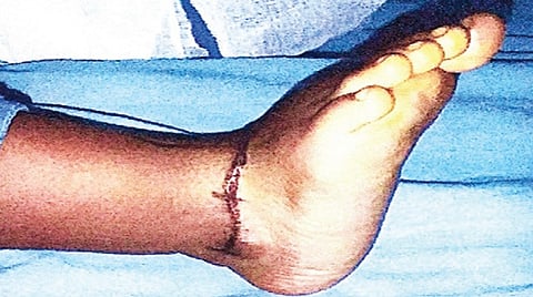 சிகிச்சைக்கு பின்னர் நேரான குழந்தையின் கால்.