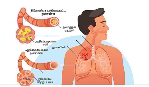 பெரியவர்கள் குழந்தைகள் கவனமாக இருக்க வேண்டிய “நிமோனியா”
