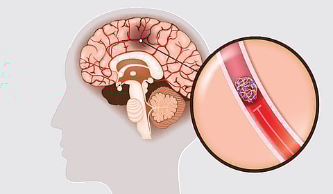 மூளையில் அடைப்பு: சிகிச்சை என்ன? | நலம் வாழ கேள்வி - பதில்