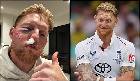 முகத்தில் படுகாயமடைந்த பென் ஸ்டோக்ஸ் - நடந்தது என்ன?