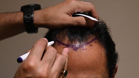 தமிழகம் முழுவதும் முடி மாற்று சிகிச்சை மையங்களுக்கு கட்டுப்பாடு