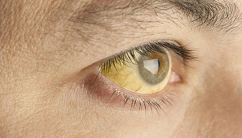 அரிசி சாப்பிட்டால் மஞ்சள் காமாலை வருமா? | டிங்குவிடம் கேளுங்கள்