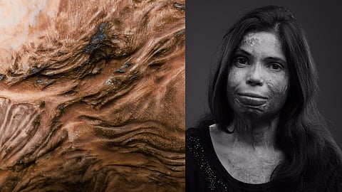 'Before You See the Scar', is a photographic and mixed-media installation created in collaboration with acid attack survivors from Delhi's Brave Souls Foundation.