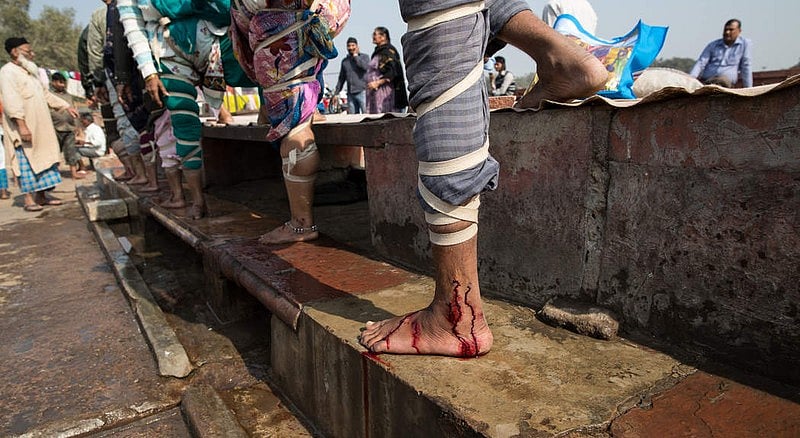 India's Archaic Medical Practice Of Bloodletting Is Still Popular