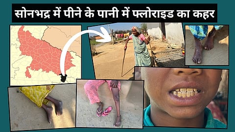 सोनभद्र : पानी में फ्लोराइड का कहर, पीले दाँतों की वजह से टूटते रिश्ते, रुकती व टूटती शादियां