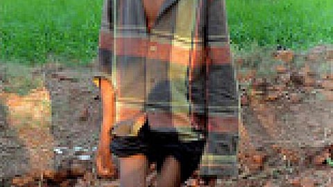 skeletal fluorosis