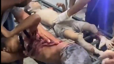 Horrific scene of Palestinian children bombed by Israeli airstrikes 10 July, 2025.