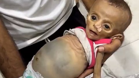 11-Month-Old Zeina Abu Hleib Succumbed to Severe Malnutrition Amid Israel's ongoing blockade of the Gaza Strip.