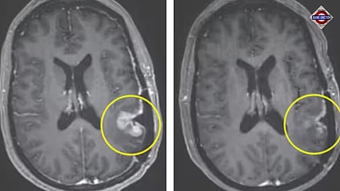 New cancer drug shows promise, made brain tumour almost disappear in 5 days