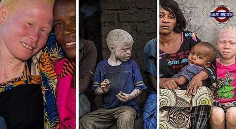 June 13 marks a global call for greater understanding and protection of people with Albinism.