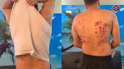 Gaurav Khanna, one of the 13 contestants on Khatron Ke Khiladi 15, recently sustained injuries during a stunt on the show.