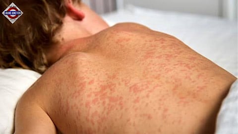 US Measles Outbreak