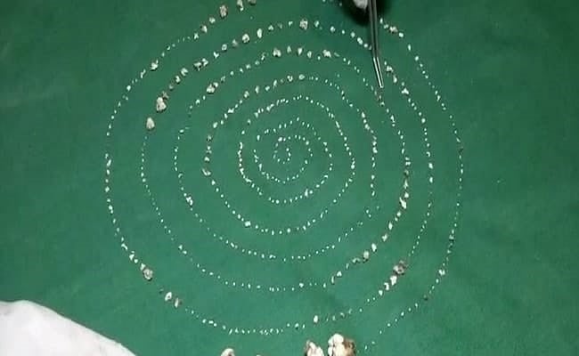 சிறுவனின் வாயில் 526 பற்கள்! - அதிர்ந்து போன மருத்துவர்கள்