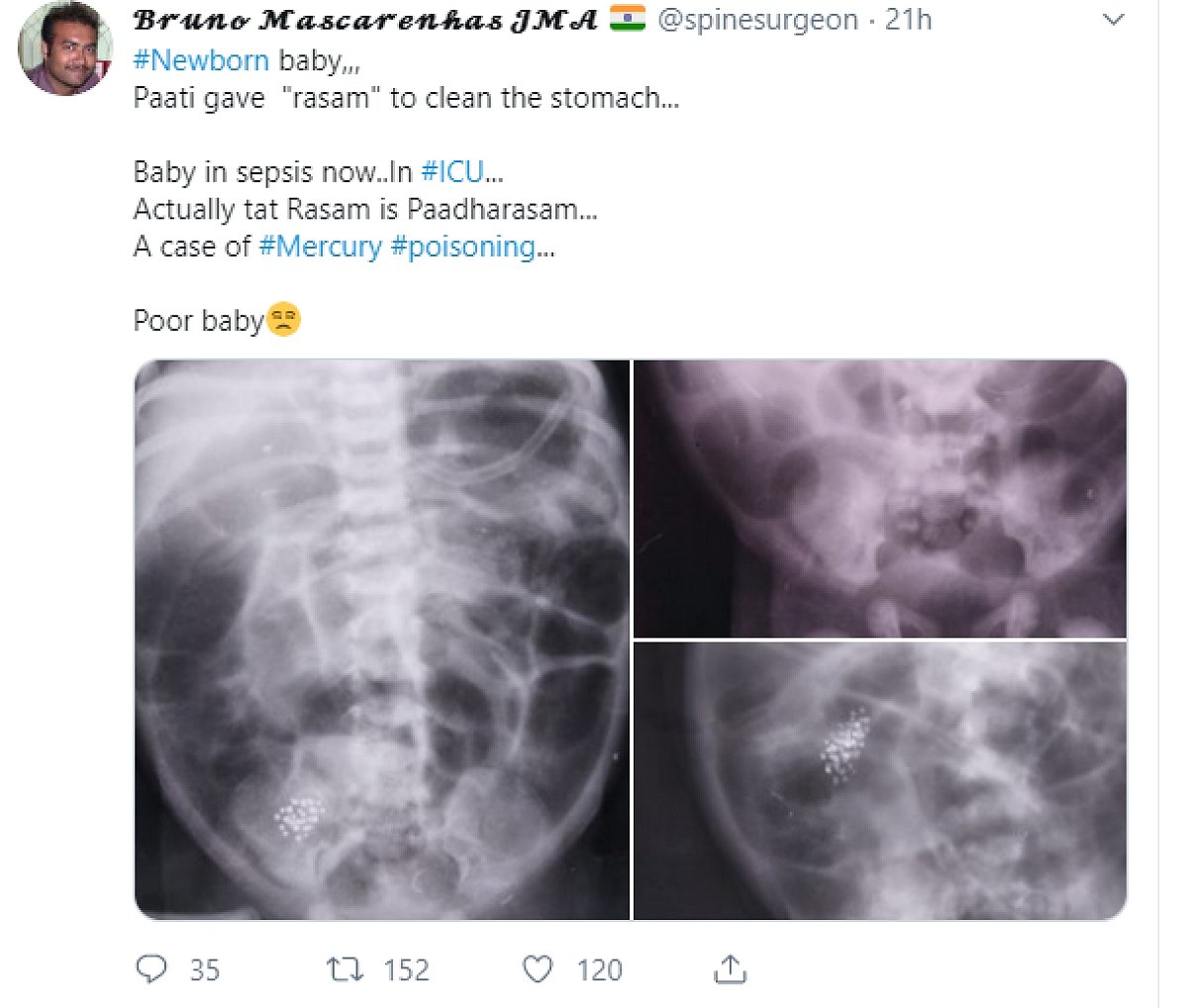 குழந்தைக்குப் பாதரசம் கொடுத்த மூதாட்டி : மூட நம்பிக்கையால் ஐ.சி.யூ-வில் உயிருக்குப் போராடும் விபரீதம்