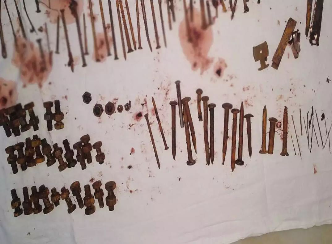 வாலிபரின் வயிற்றில் 3.5 கிலோ இரும்பு பொருட்கள் : அறுவை சிகிச்சையில் அதிர்ச்சி அடைந்த மருத்துவர்கள் ! ஏன்?