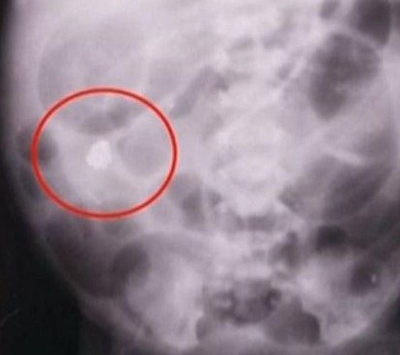 குழந்தைக்குப் பாதரசம் கொடுத்த மூதாட்டி : மூட நம்பிக்கையால் ஐ.சி.யூ-வில் உயிருக்குப் போராடும் விபரீதம்