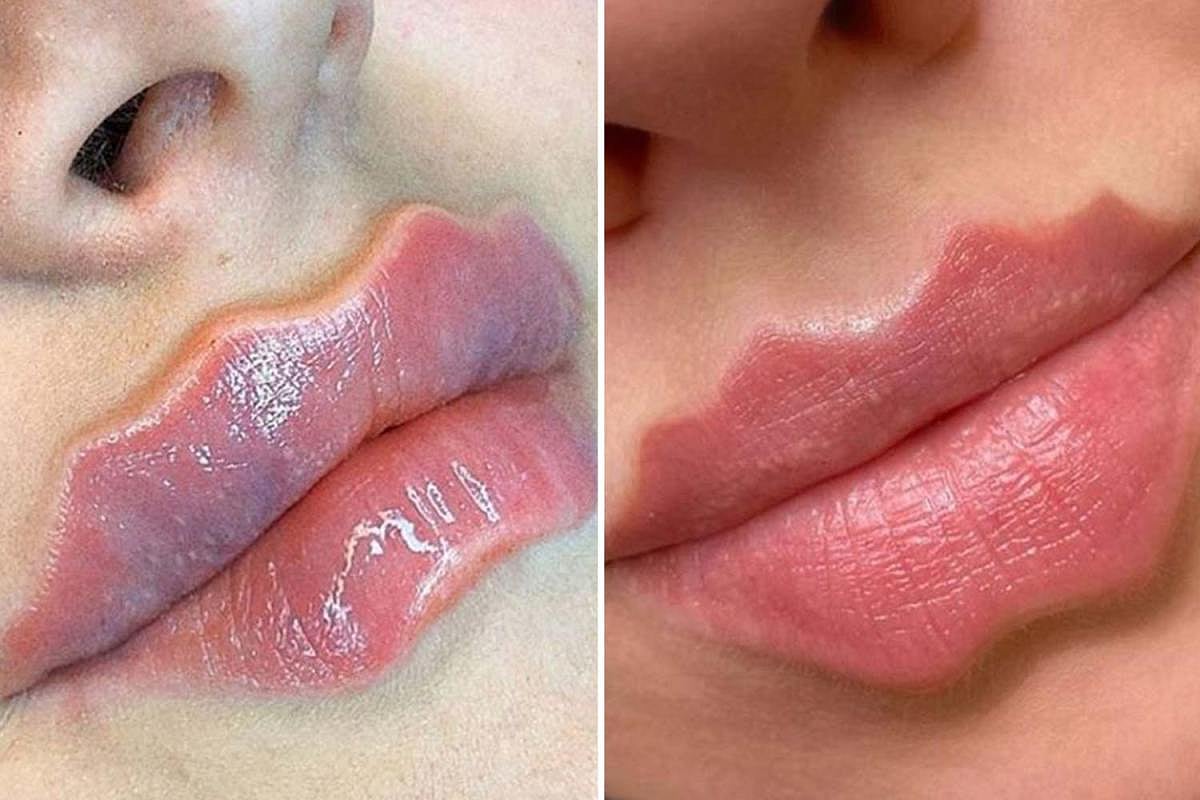 Devil Lips : சமூக வலைதளத்தில் ட்ரெண்ட் ஆகும் நூதன சேலஞ்ச் - எச்சரிக்கும் தோல் நிபுணர்கள்!