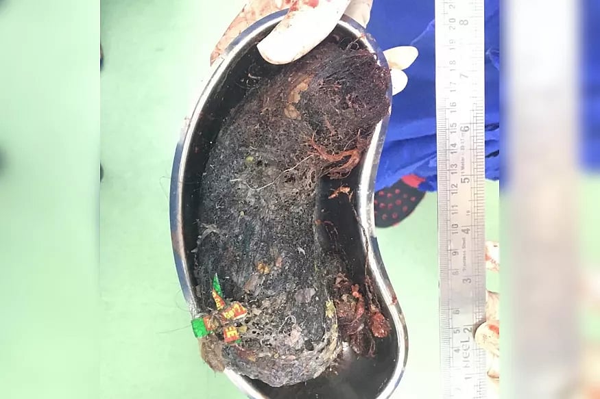 13 வயது பெண்ணின் வயிற்றில் அரை கிலோ தலைமுடி, பிளாஸ்டிக் பைகள் : கோவையில் மன அழுத்தத்தால் விபரீதம் 