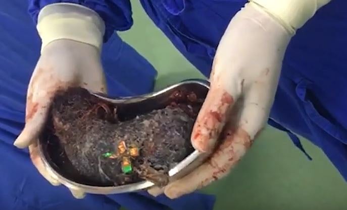 13 வயது பெண்ணின் வயிற்றில் அரை கிலோ தலைமுடி, பிளாஸ்டிக் பைகள் : கோவையில் மன அழுத்தத்தால் விபரீதம் 