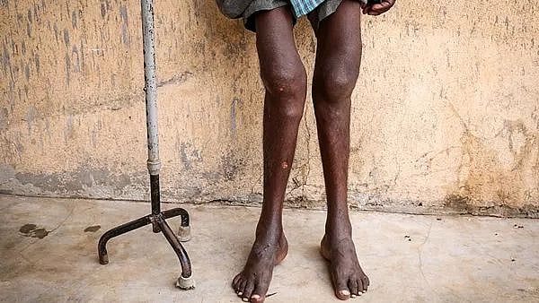 தங்க சுரங்கம் வதந்திக்கு காரணமான கிராமங்களில் பரவும் இந்த நோய் குறித்து தெரியுமா ? - உ.பி சோகம் !