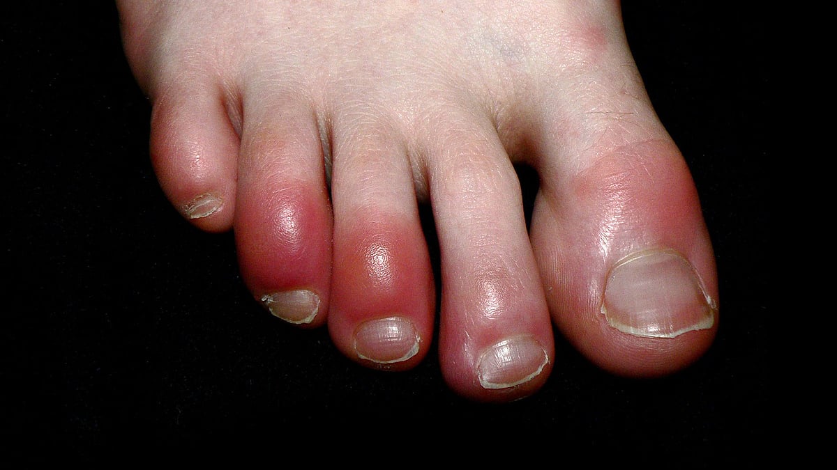 கால் விரல்கள் சிவந்து வீங்குவது கொரோனா அறிகுறியா? - தோல் மருத்துவர்கள் புதிய தகவல்!