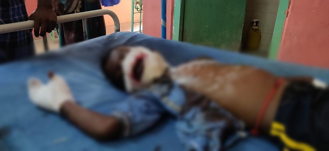 “அன்று யானை... இப்போது சிறுவன்” - வன விலங்குகளைக் கொல்ல வைக்கப்பட்ட வெடிகுண்டை கடித்த சிறுவன் படுகாயம்!