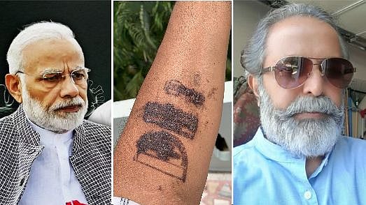 “கொரோனா முத்திரையால் தோல் பாதிப்பு?” : கை கருப்பாக மாறி ‘செப்டிக்’ ஆனதாக காங்கிரஸ் தலைவர் குற்றச்சாட்டு!