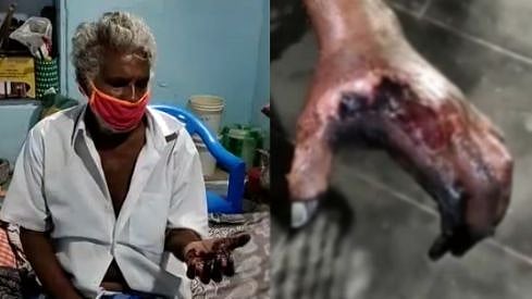 “அரசு மருத்துவமனையின் தவறான சிகிச்சையால் விரல்கள் பாதிக்கப்பட்ட கொடுமை” : முசிறி விவசாயி கண்ணீர் பேட்டி!