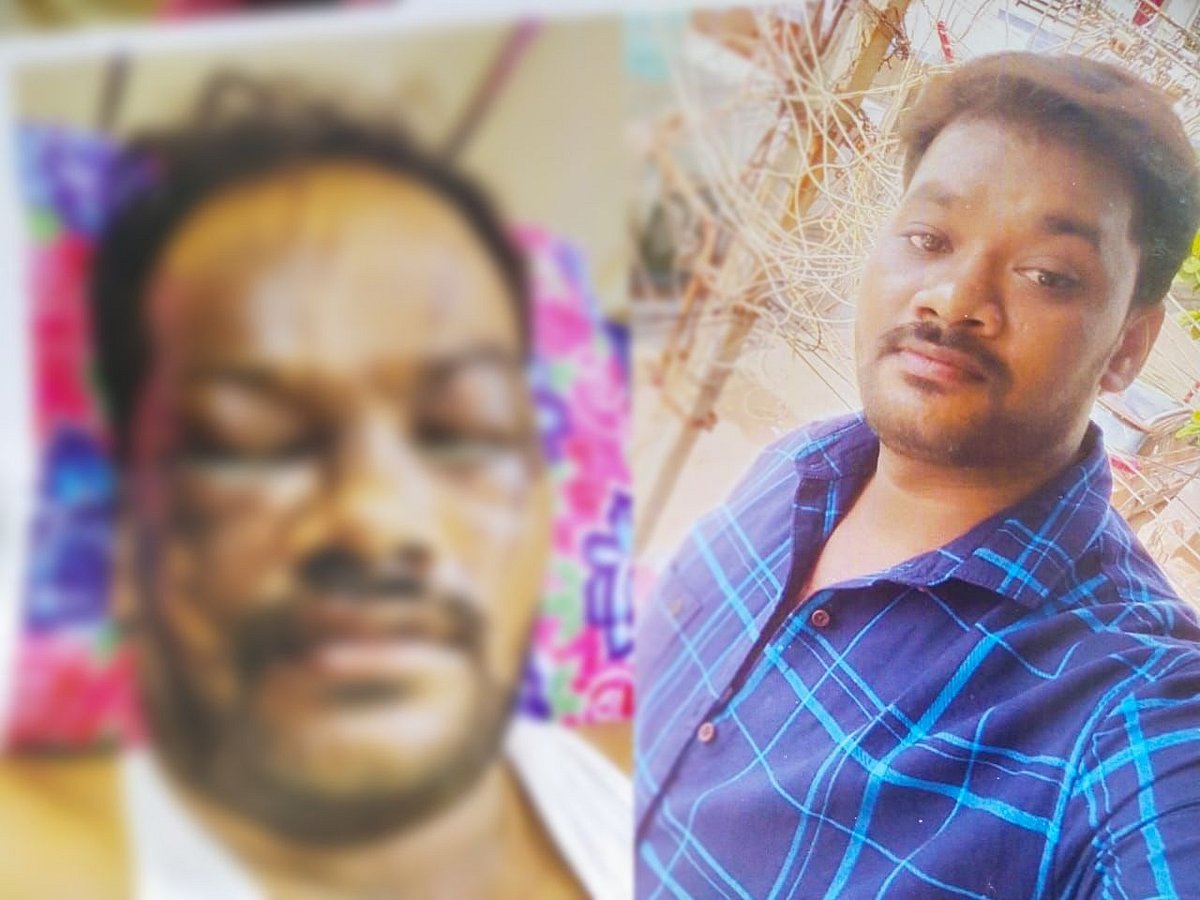 “கிருமிநாசினி இயந்திரம் வெடித்து பார்வை இழந்த மாநகராட்சி பணியாளர்” : மதுரையில் நடந்த சோகம்!