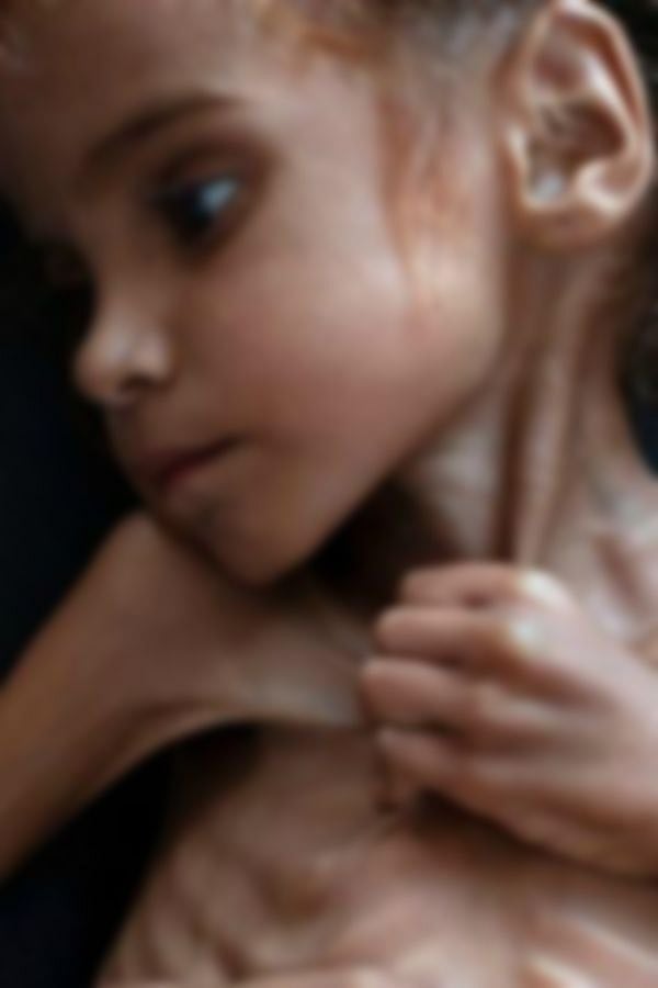 ஏமனின் அவலத்தை உலகத்துக்குக் காட்டிய 13 வயது சிறுமி : பட்டினியில் வாடும் 4 லட்சம் குழந்தைகள் !