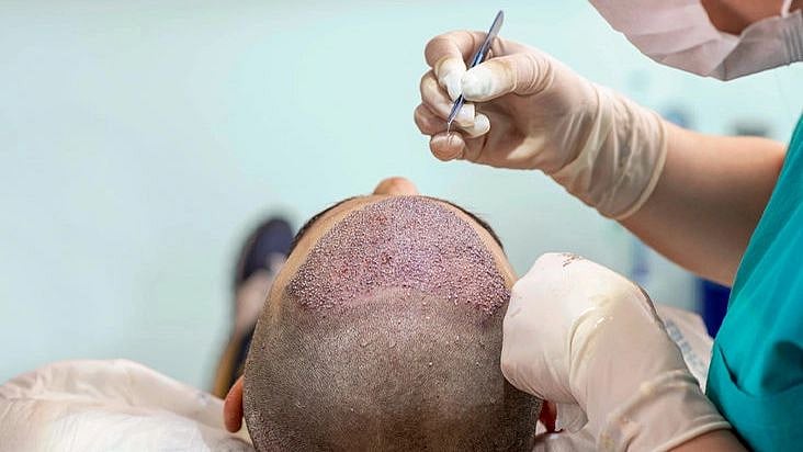 ஆபரேஷன் செய்த 3வது நாளே பலி; முடி மாற்று சிகிச்சையில் அலட்சியம்? - குஜராத்தில் நடந்த பகீர் சம்பவம்!