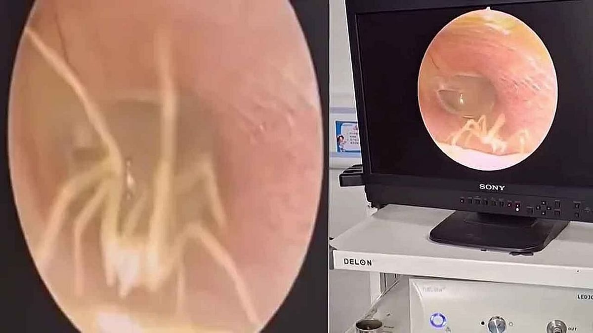 "ஒரு நாள் முழுக்க காதில் குடியிருந்த சிலந்தி" : மருத்துவமனை சென்ற பெண்ணுக்கு காத்திருந்த அதிர்ச்சி!