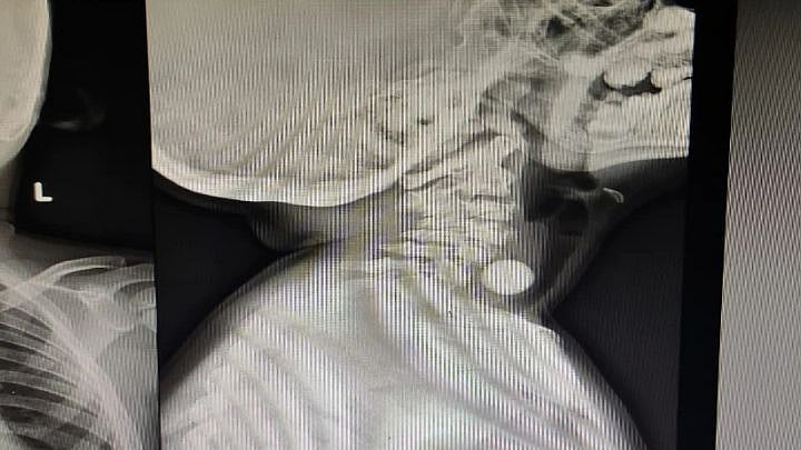 தொண்டையில் சிக்கிய கோலிக் குண்டு.. 3 மணி நேரத்தில் அறுவை சிகிச்சை இல்லாமல் அகற்றிய அரசு மருத்துவமனை!