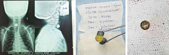 வலியால் துடித்த 2 சிறுவர்களை அறுவை சிகிச்சையின்றி காப்பாற்றிய அரசு மருத்துவர்கள்: திருவண்ணாமலையில் சாதனை!