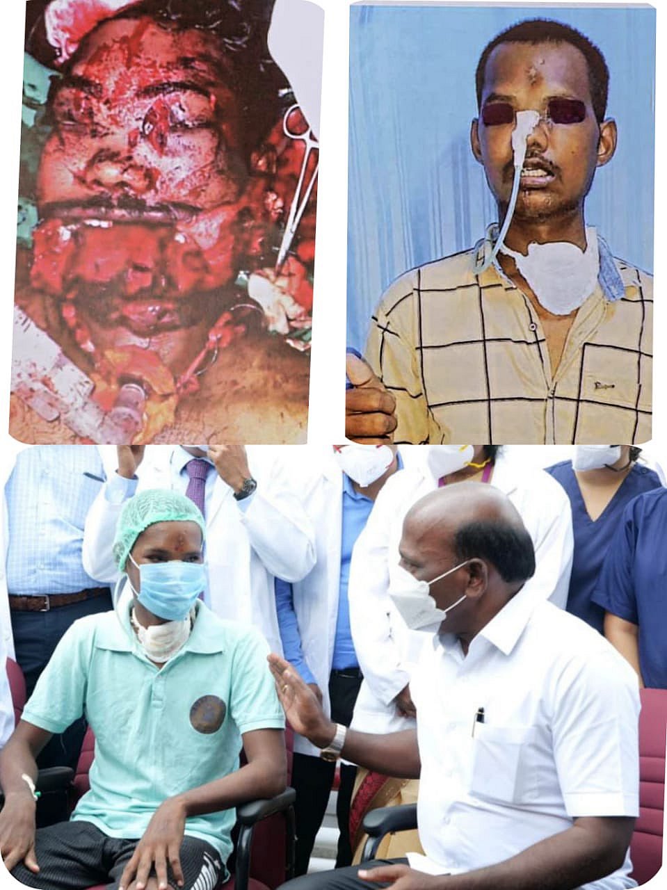 “துப்பாக்கியால் சுட்டு முகம் சிதைந்த காவலரைக் காப்பாற்றிய அரசு மருத்துவர்கள்” : அமைச்சர் மா.சு பாராட்டு!