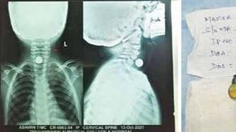 வலியால் துடித்த 2 சிறுவர்களை அறுவை சிகிச்சையின்றி காப்பாற்றிய அரசு மருத்துவர்கள்: திருவண்ணாமலையில் சாதனை!