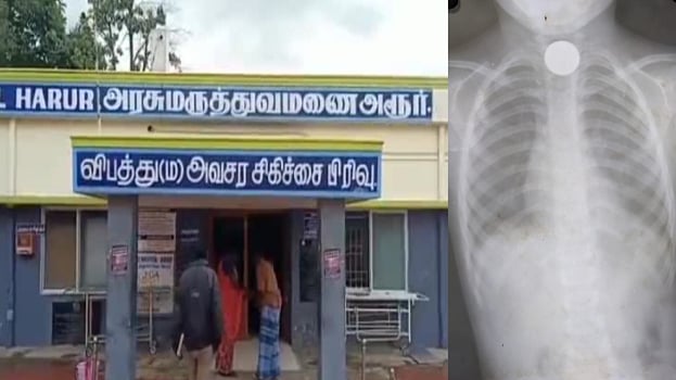 5 ரூபாய் நாணயத்தை விழுங்கி உயிருக்கு போராடிய சிறுவன்: துரிதமாக செயல்பட்டு காப்பாற்றிய அரசு மருத்துவர்கள்!