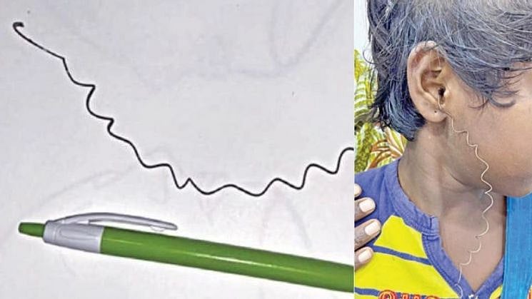 காது குடைந்ததால் வந்த வினை.. சிறுமி காதில் மாட்டிக்கொண்ட சுருள் கம்பியை அகற்றிய அரசு மருத்துவர்!