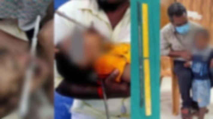 2 வயது குழந்தையின் வாயில் குத்திய 59 செ.மீ கம்பி.. 45 நிமிடத்தில் அகற்றிய அரசு மருத்துவமனை: நடந்தது என்ன?