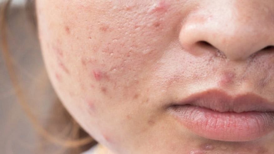 முகப்பரு வந்ததால் மனைவிக்கு டார்ச்சர்: நிர்வாண படத்தை காட்டி மிரட்டிய சாஃப்ட்வேர் கணவனுக்கு காப்பு!