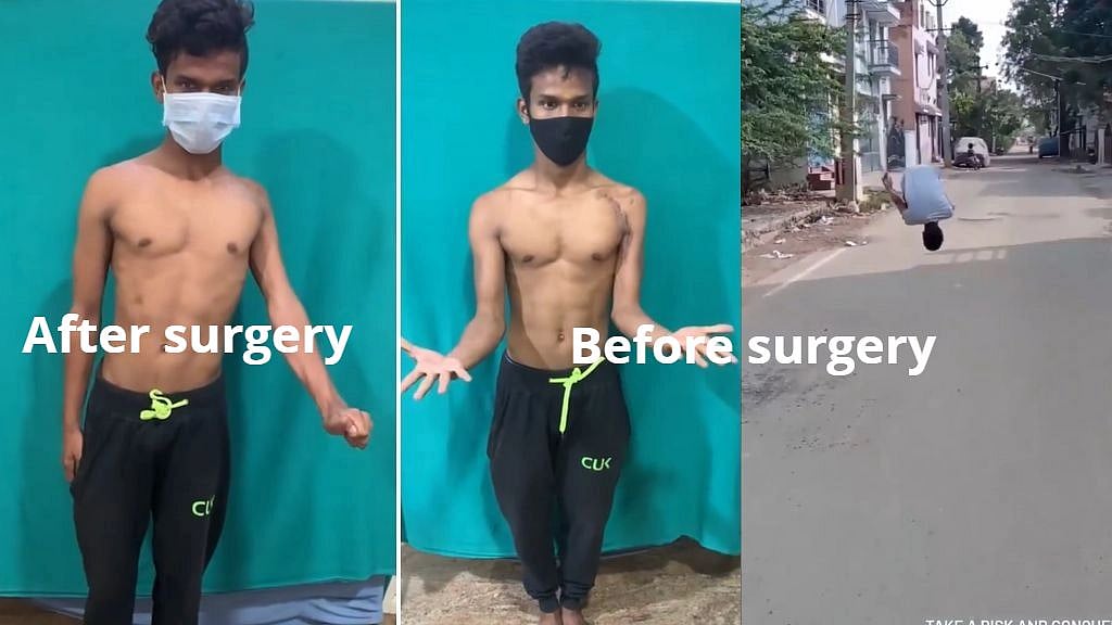 ஒரு ரூபாய் செலவில்லாமல் அறுவைசிகிச்சை.. மீண்டெழுந்த ஜிம்னாஸ்டிக் வீரர் - அரசு மருத்துவர்கள் அசத்தல்!