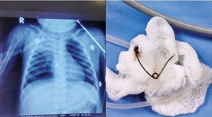 ஊக்கினை விழுங்கிய 8 மாத குழந்தைக்கு புது வாழ்வை கொடுத்த திருச்சூர் மருத்துவக் கல்லூரி மருத்துவர்கள்!