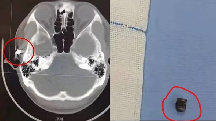 “20 ஆண்டுகளாக தொடர் தலைவலி.. சிகிச்சைக்கு சென்றவர் தலையில் இருந்த துப்பாக்கி குண்டு” : ‘பகீர்’ சம்பவம்!