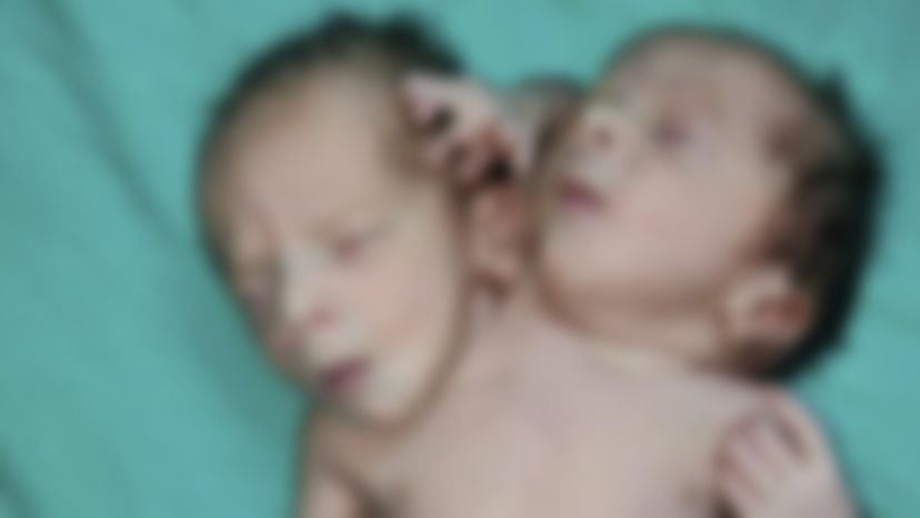 ’ஓர் உடல்.. இரண்டு தலைகள்’: இந்தியாவில் ஒட்டிப் பிறந்த அதிசய குழந்தை - எங்கு தெரியுமா?