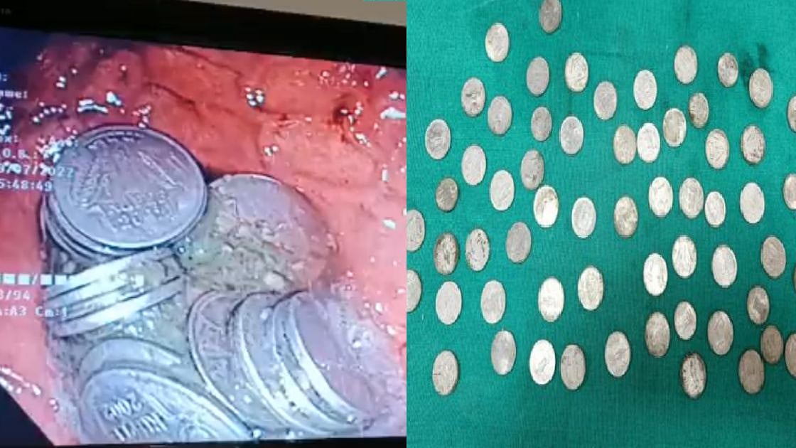 இப்படியும் நடக்குமா? : வயிற்று வலி.. வாலிபருக்கு அறுவை சிகிச்சை செய்தபோது அதிர்ந்து போன டாக்டர்கள் !