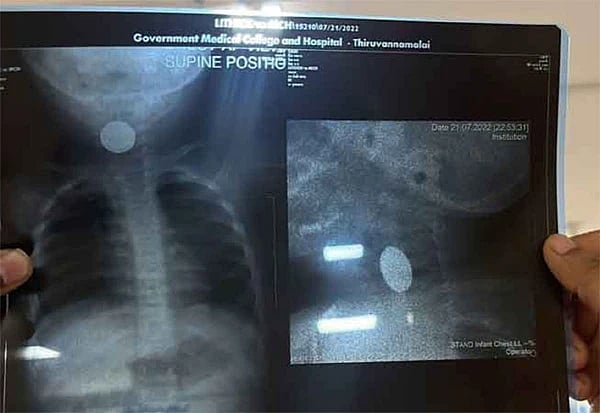 குழந்தையின் தொண்டையில் சிக்கிய பேட்டரி.. அறுவை சிகிச்சையின்றி அகற்றம் - தமிழக அரசு மருத்துவர்கள் சாதனை!