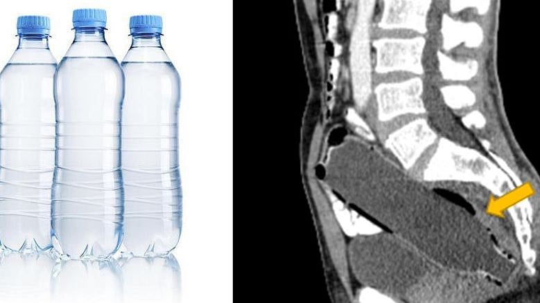 50 வயது நபரின் ஆசன வாய் பகுதியில் சிக்கிய வாட்டர் பாட்டில்.. நடந்தவற்றை கேட்டு மருத்துவர்கள் அதிர்ச்சி!